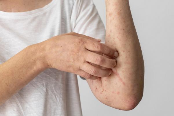 Virus de la viruela símica